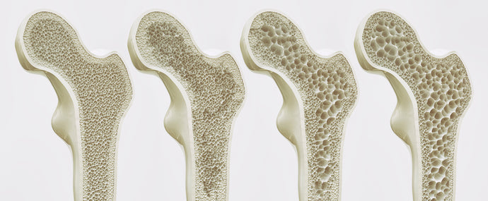Osteoporose - NATÜRLICH vorbeugen
